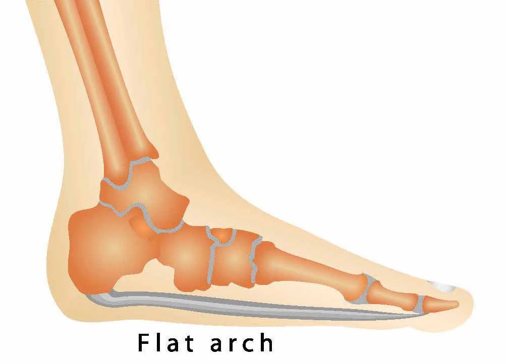 Injury Advice Flat Feet Cause, Treatment and Cure ENERTOR®