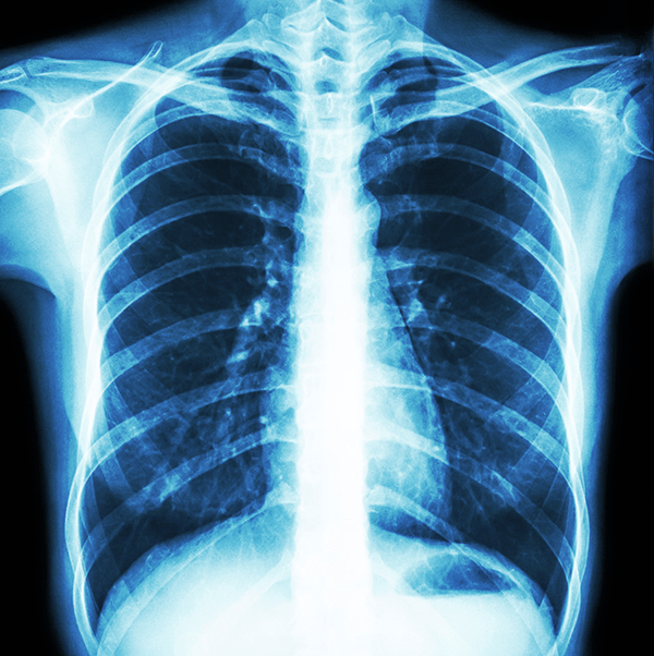 chestxray.png Samueli School of Engineering at UC Irvine