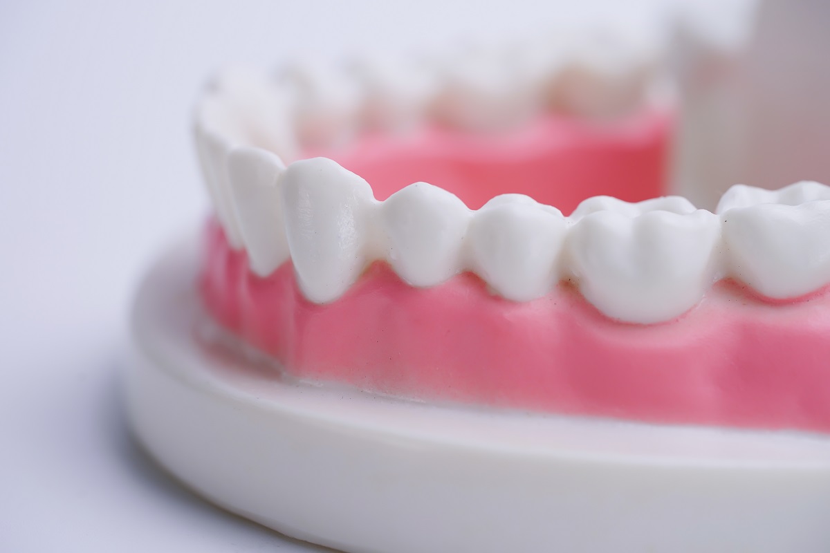 A ready reckoner for Gingivitis Ensure Dental Care