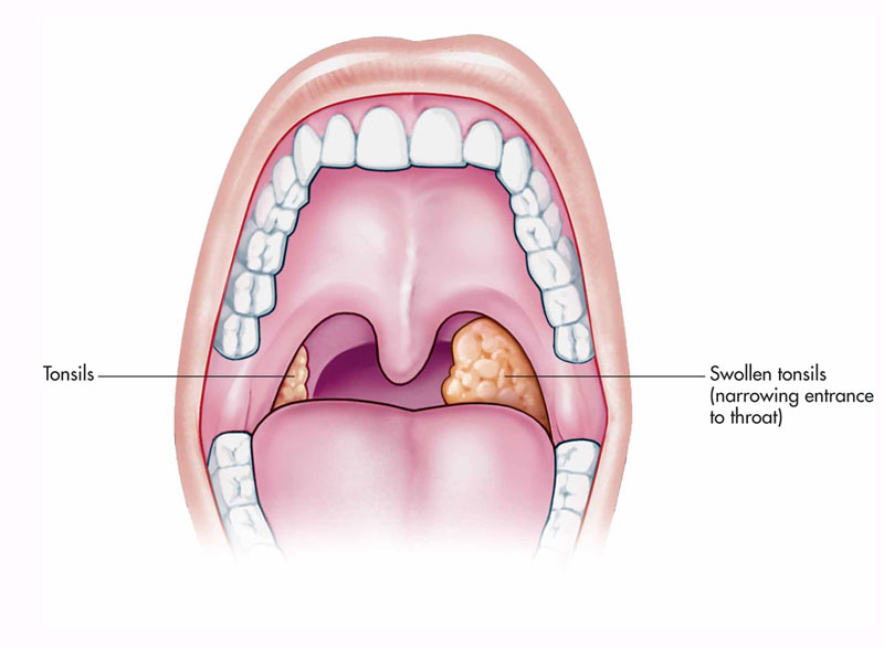Tonsillitis, Causes, Symptoms, Treatment, Surgery - Ent Clinic
