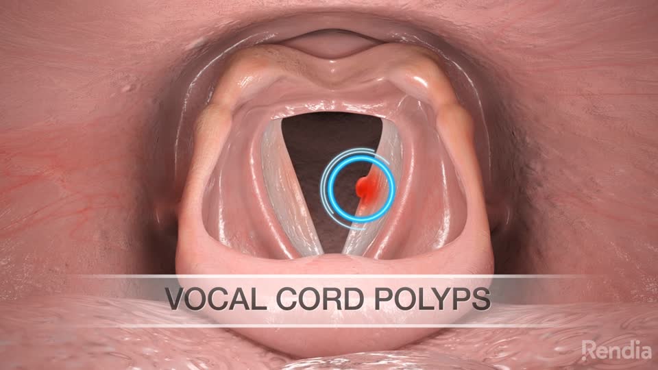Vocal Cord Polyps Overview ENTJC