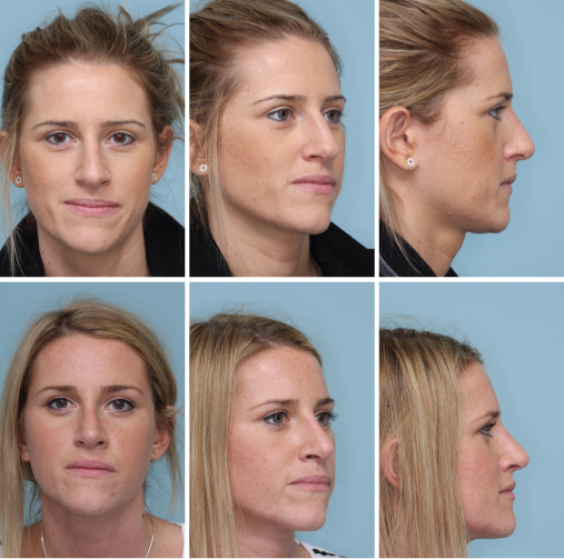 Facial Plastics Ento Key