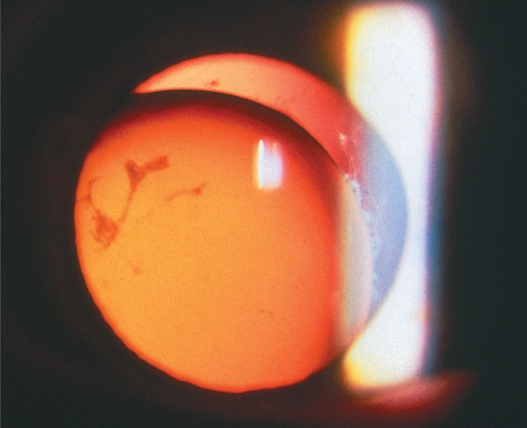 11 Lens/Cataract Ento Key