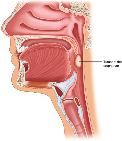 Tumors of the Pharynx Ento Key
