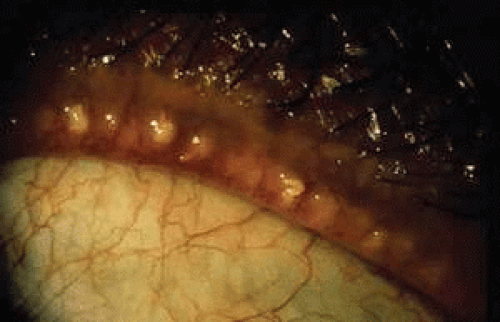 Blepharitis and Inflammation of the Eyelids Ento Key