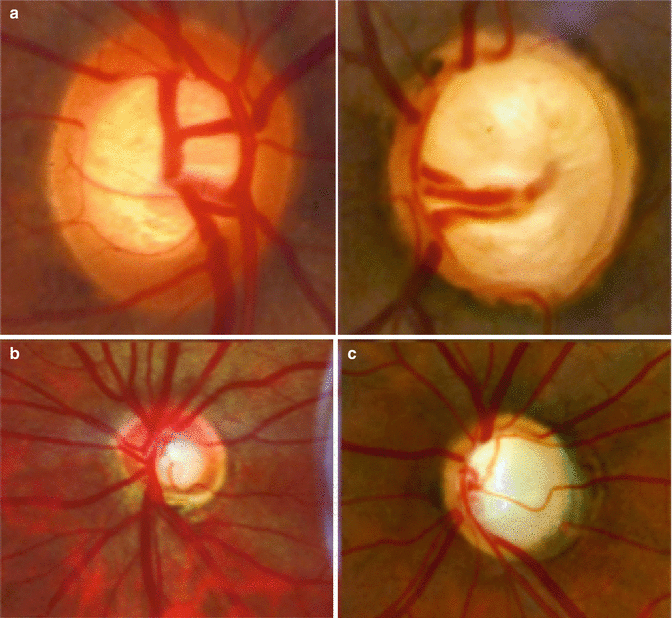 Clinical Examination of the Optic Nerve Ento Key