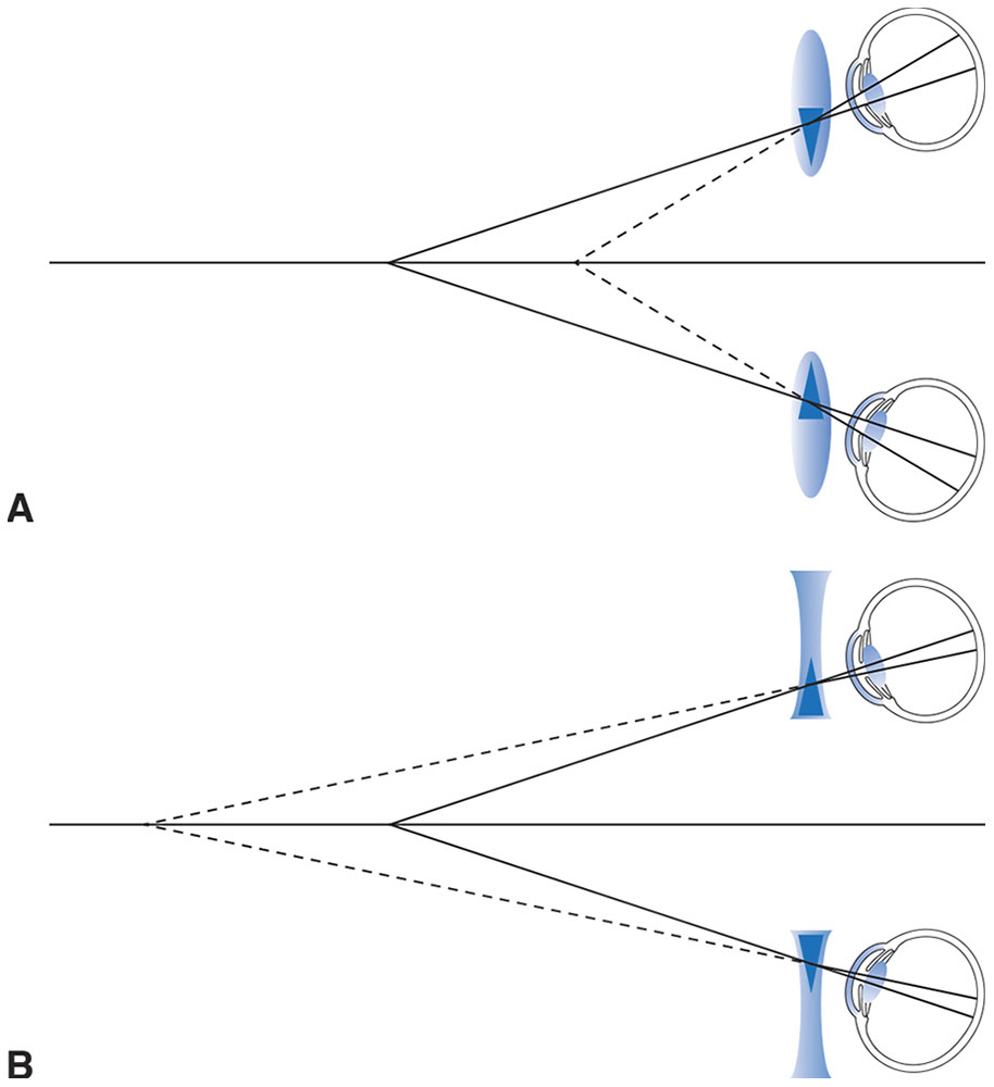 Contact Lenses Ento Key