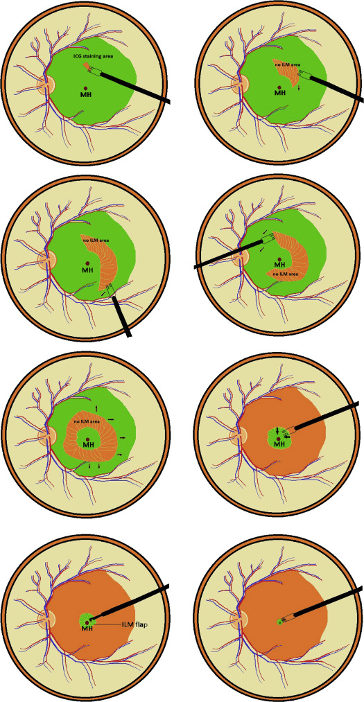 Inverted Internal Limiting Membrane Insertion for Macular Hole
