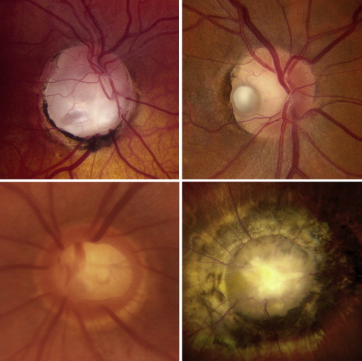 Pathogenesis and Treatment of Maculopathy Associated With Cavitary