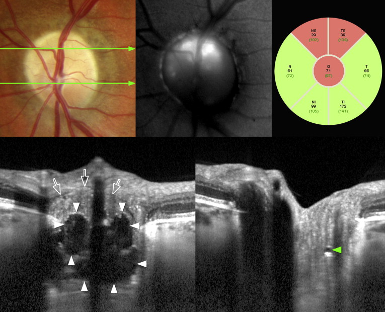 Multimodal Imaging of Optic Disc Drusen Ento Key