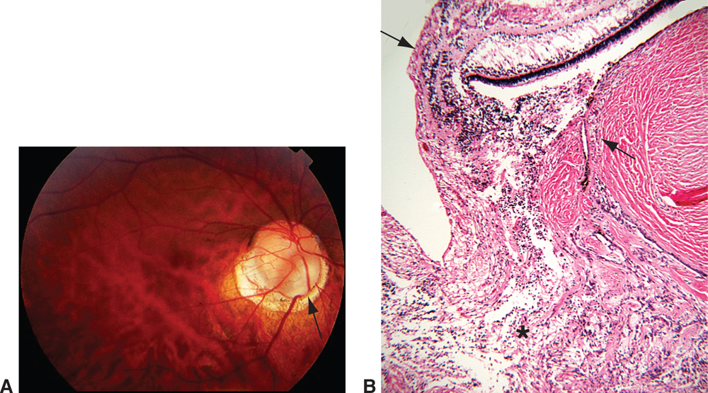 Optic Nerve Ento Key