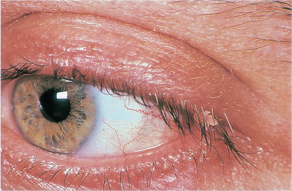 Classification and Management of Eyelid Disorders Ento Key