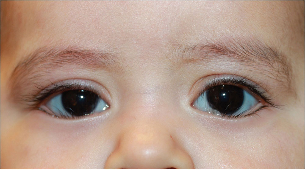 Classification and Management of Eyelid Disorders Ento Key