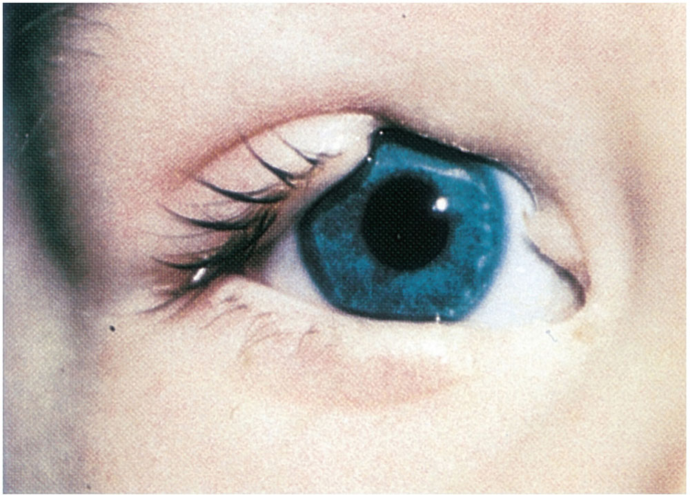 Classification and Management of Eyelid Disorders Ento Key