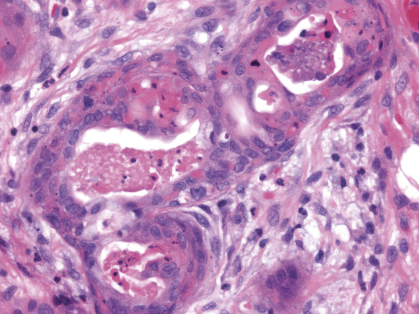 Head and Neck Pathology Ento Key