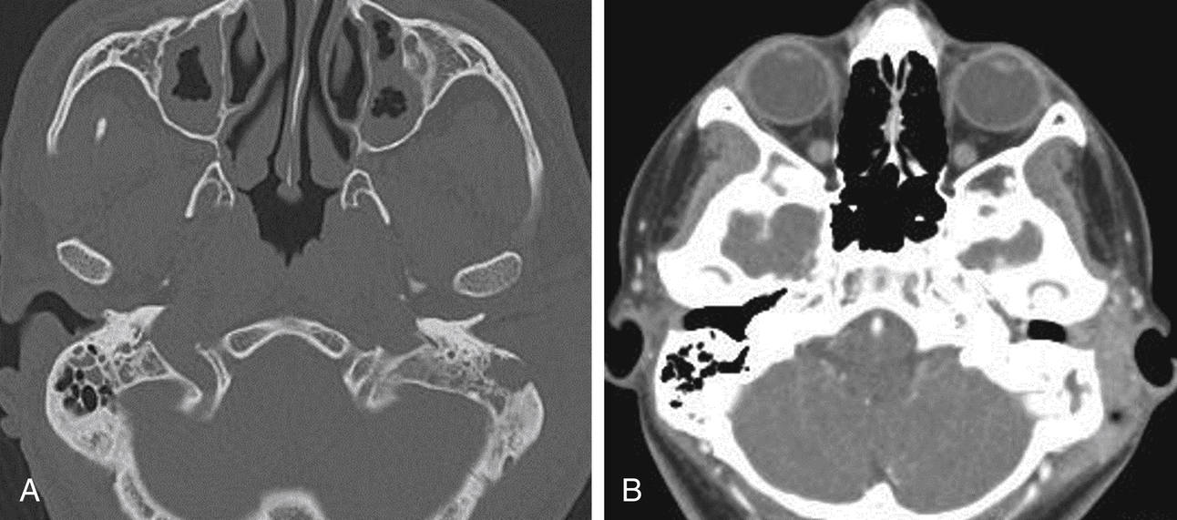 Haller Air Cells Radiology Anatomy In the ct image haller cells are