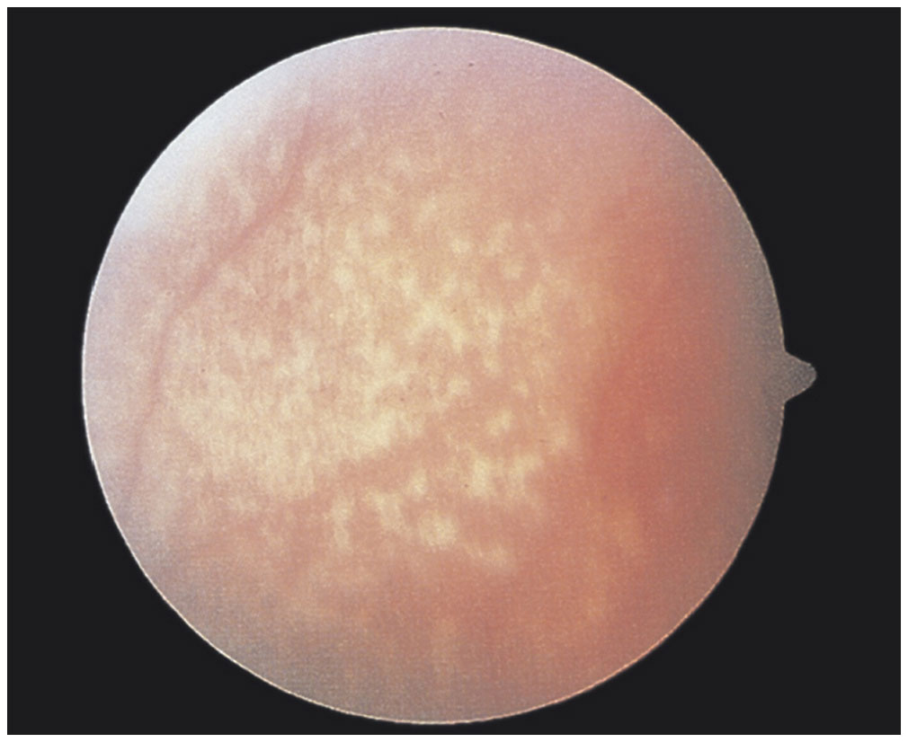 Disorders of the Retina and Vitreous Ento Key