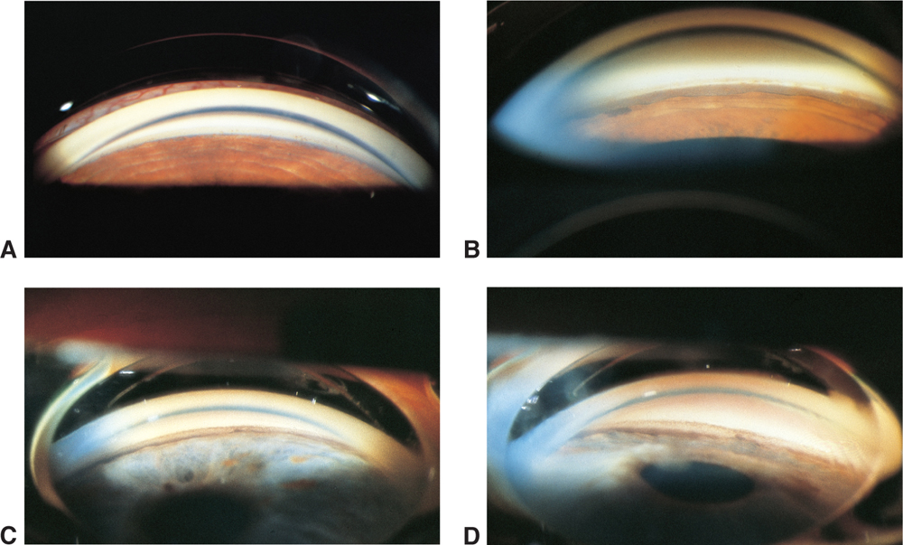 Gonioscopy Angle Grading