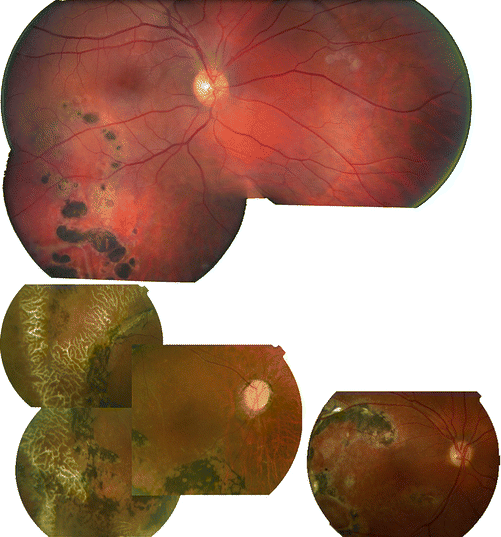 XLinked Retinoschisis Ento Key