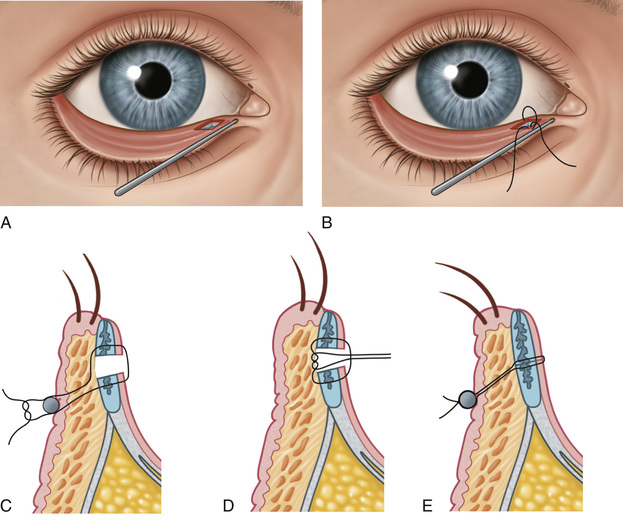 Lower Eyelid and Eyelash Malpositions Ento Key