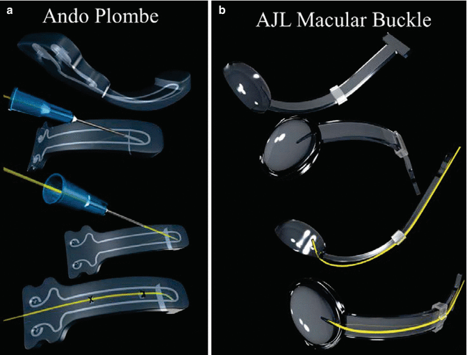 Macular Buckling Technique in High Myopia Ento Key