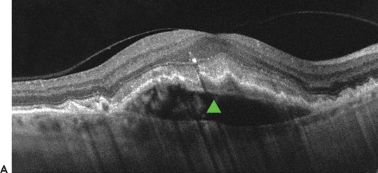Optical Coherence Tomography | Ento Key