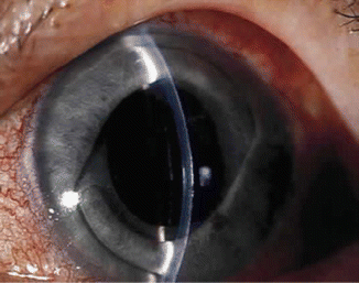 Anterior Chamber Intraocular Lens in Posterior Capsular Rent | Ento Key