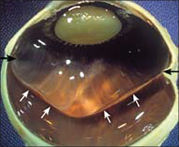 Vitreous Humor | Ento Key