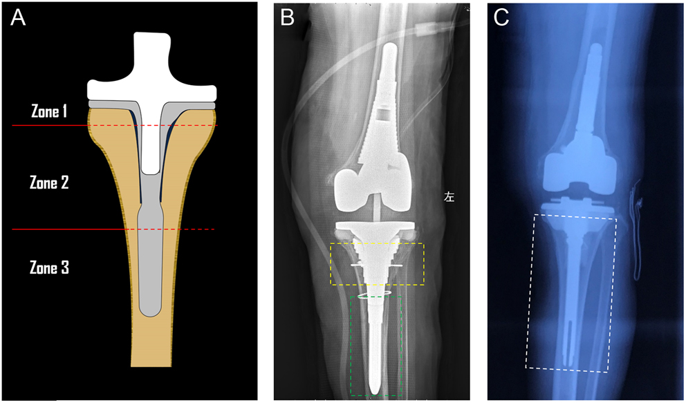 Prostheses option in revision total knee arthroplasty, from the bench