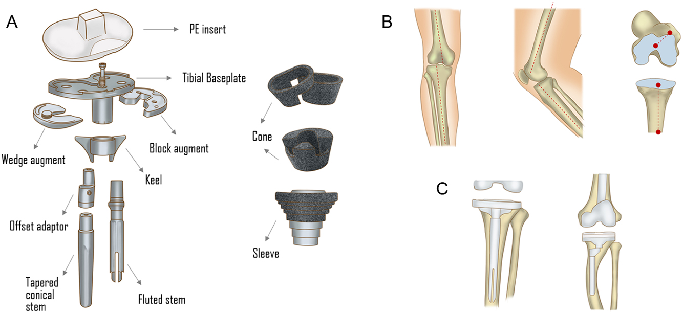 Prostheses option in revision total knee arthroplasty, from the bench