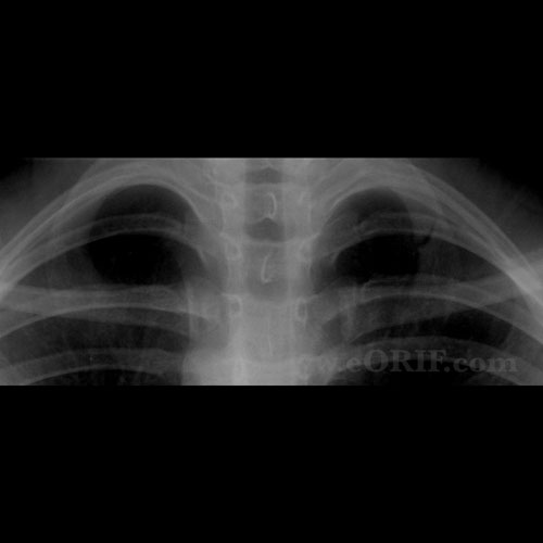 Rib Stress Fracture Images eORIF