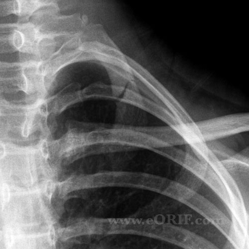 Rib Fracture Icd 10 Code at Lester Bentley blog