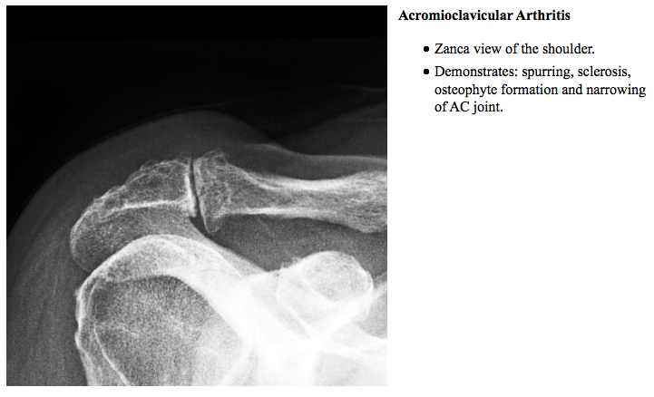 Distal Clavicle Resection 29824 eORIF