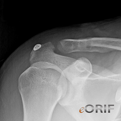 Acromioclavicular Joint Reconstruction 23552 eORIF