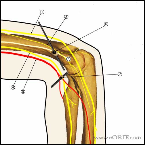 Cubital Tunnel Syndrome G56.20 354.2 eORIF
