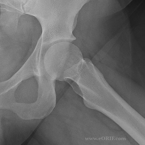 Hip Xray eORIF