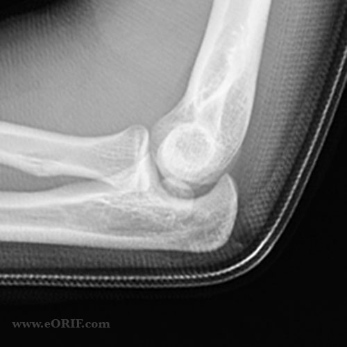 Left Hip Fracture Icd 9 Therapy Fracture