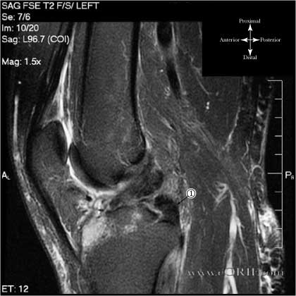 PCL Reconstruction 29889 | eORIF