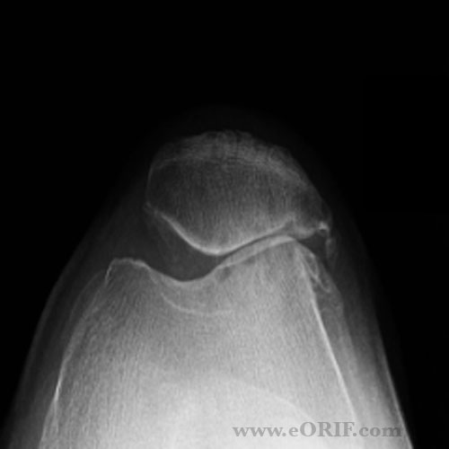 Patellofemoral Arthritis Images eORIF