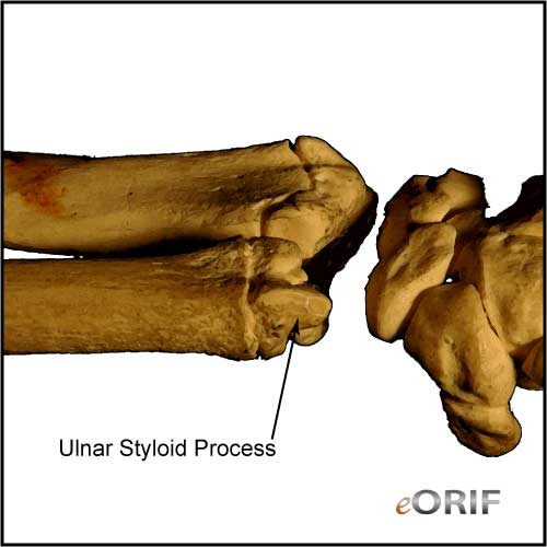 Ulnar Impaction Syndrome Icd 10 Captions Todays