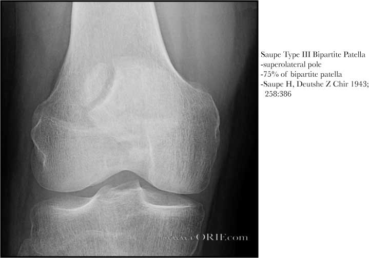 Bipartite Patella Q68.2 755.64 eORIF