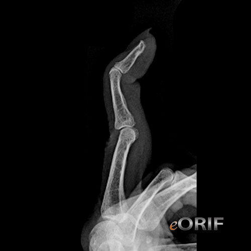 Boutonniere Deformity M20.029 736.21 eORIF