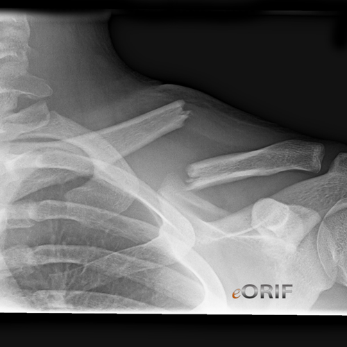 Icd 10 Code For Post Op Shoulder Surgery