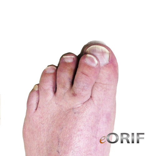 Crossover Toe M20.5X9 735.8 eORIF