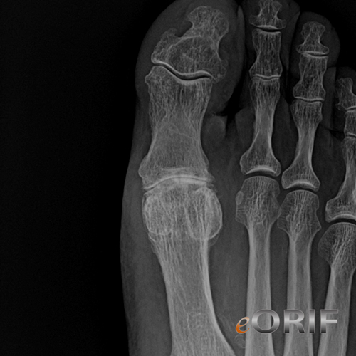 Hallux Rigidus M20.20 735.2 eORIF