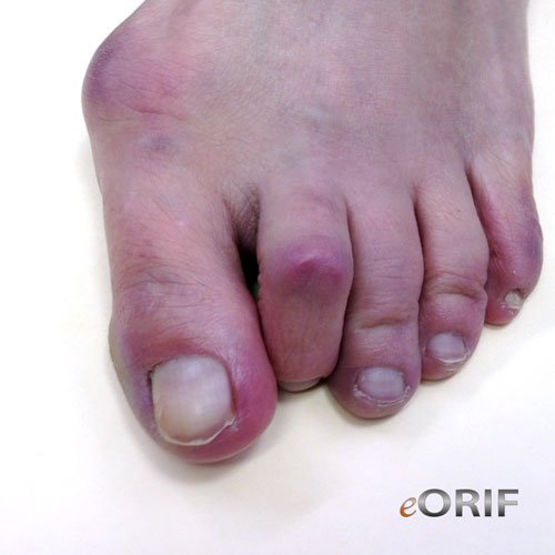 Hammer Toe M20.40 735.4 eORIF