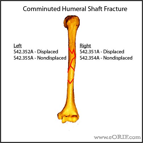 Humeral Shaft Fracture Classification eORIF