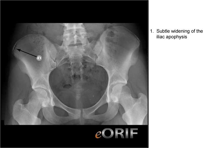 Iliac Apophysitis M93.90 732.9 eORIF