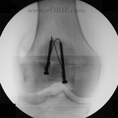 Patella Fracture S82.009A 822.0 eORIF