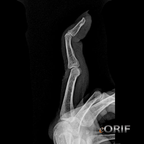 Swan Neck Deformity M20.039 736.22 eORIF